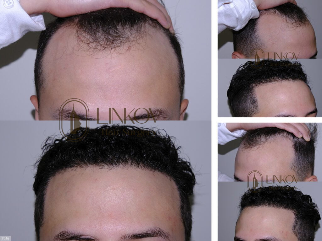 glutathione trichotillomania Trichotillomania (Hair Pulling) Treatment NYC