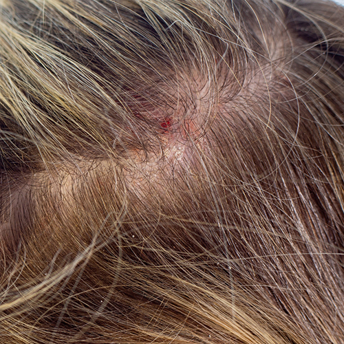 Scalp Folliculitis Hair Loss Scalp Folliculitis Hair Loss