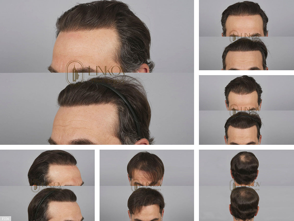 Hair Transplant Repair & Revision