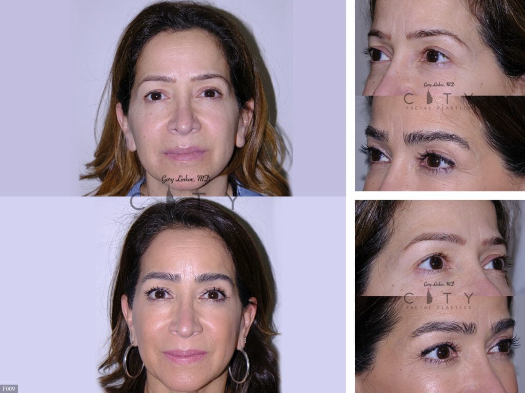 Hair-Transplant-F009