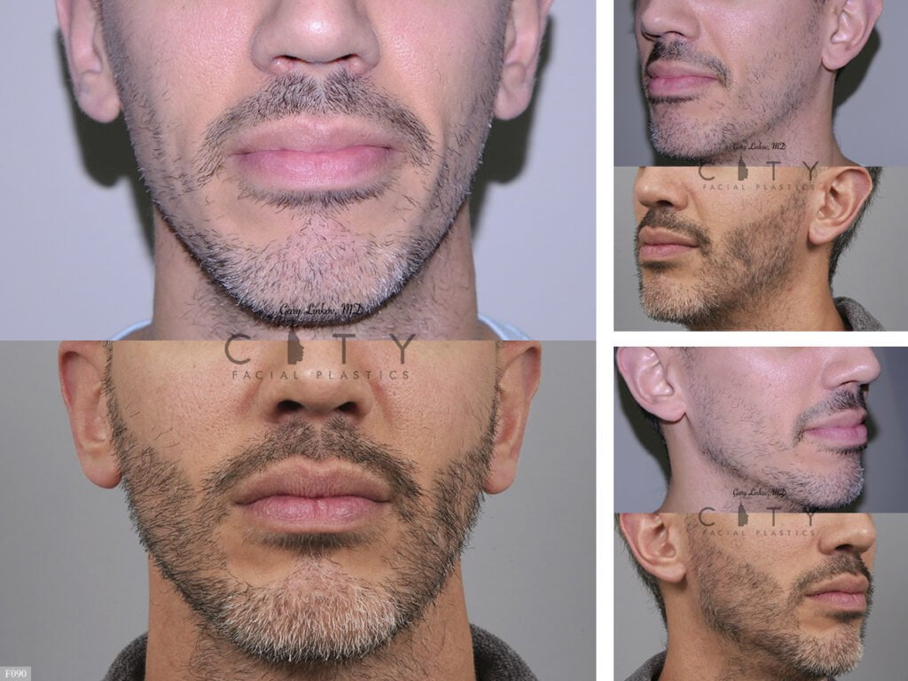 Hair-Transplant-F090